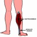 gastrocnemius-muscle-of-calf